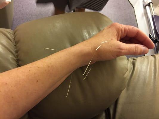 She puts the needles in so quickly, there is no pain. The result it's awesome!