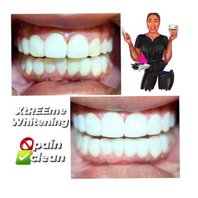 Xtreme whitening