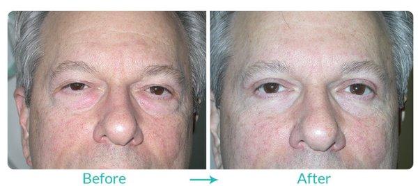 Before and After: Blepharoplasty (Excess Eyelid Skin) and Lower Blepharoplasty by Dr. Steven C. Dresner