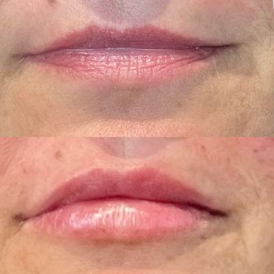 Before/After Juvederm