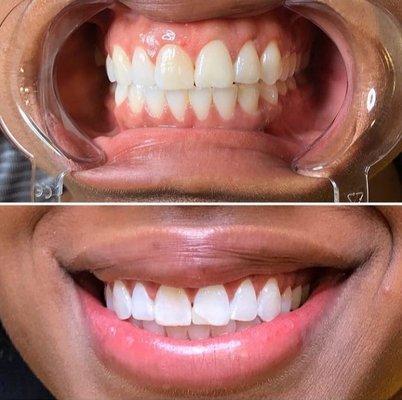 cosmetic teeth whitening