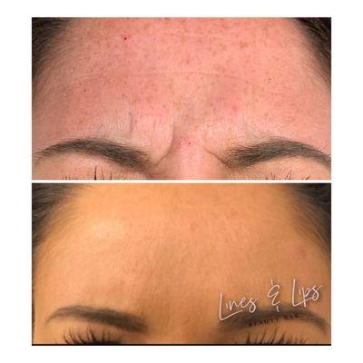 Glabellar Botox Treatment (11's)