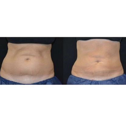 Coolsculpting of the flanks and abdomen.