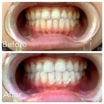 LED teeth whitening