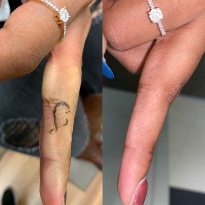 Before and after tattoo removal