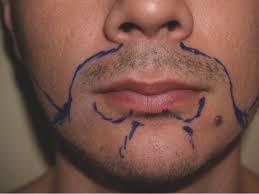 Beard line area treated with electrolysis. Cheeks, goatee, top of nose, unibrow, etc.