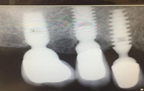 Dental Implants-X-ray