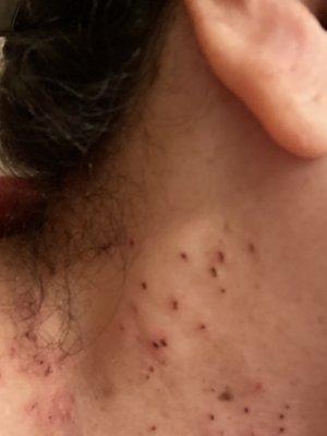 Skin tags