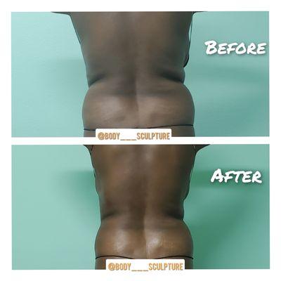 Lower back bodysculpting