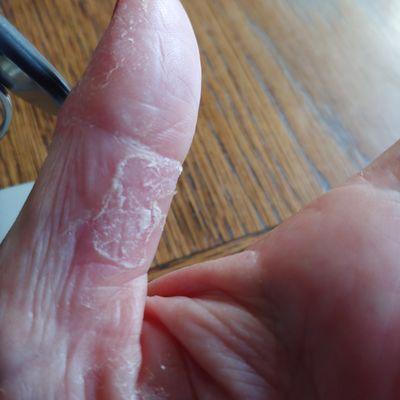 Cracked skin on thumb