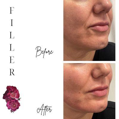 Dermal filler done by Kelly