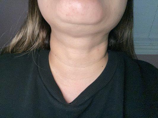 Bad botched chin/lipo surgery