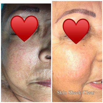 Treated broken capillaries with the Skin Sheek Clear. Using high frequency.