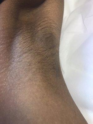 Underarm waxing using Nudesse Nufree.