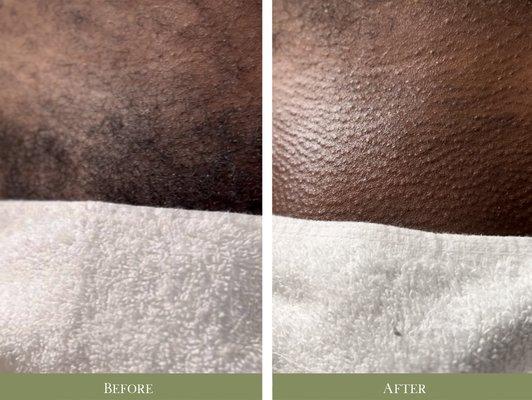 Make Brazilian Before & After. Mello Esthetics has Gender Neutral Booking & Pricing!