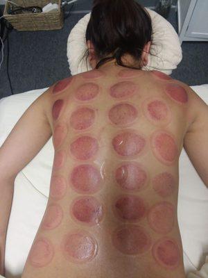 Tuyet, my massage therapist did a cupping and deep tissue massage. Very therapeutic. I have been seeing her for 2 years. Highly recommend