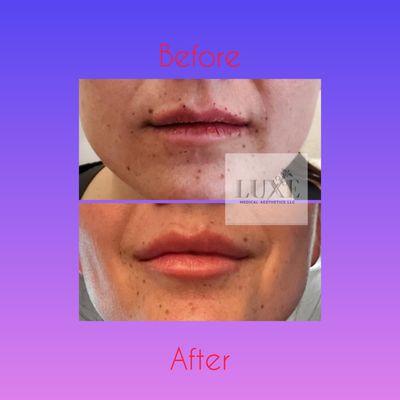 Lip filler Before & After