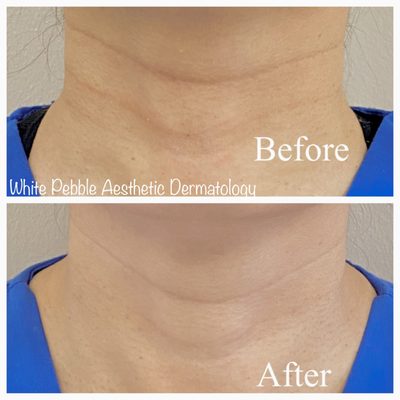 Neckline significantly improved after just 2 microneedling treatments.