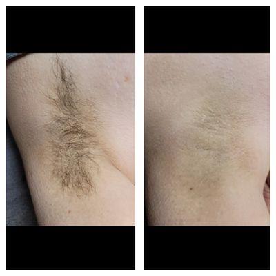 Before and after of an underarm wax