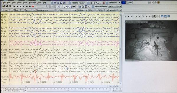 CNS Neuromonitoring