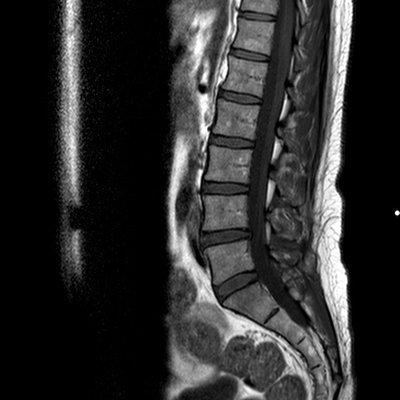 mri of the spine