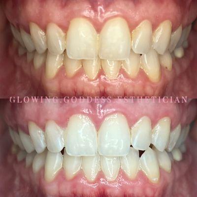 Teeth Whitening: 40 Minutes