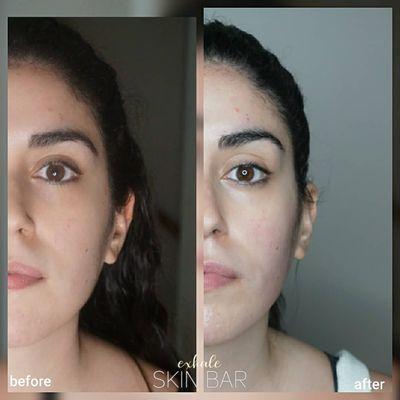 Sculptural Face Lifting w. Lymphatic Drainage & Gua Sha Results