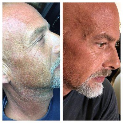 Microneedling + plasma ion 5 day results