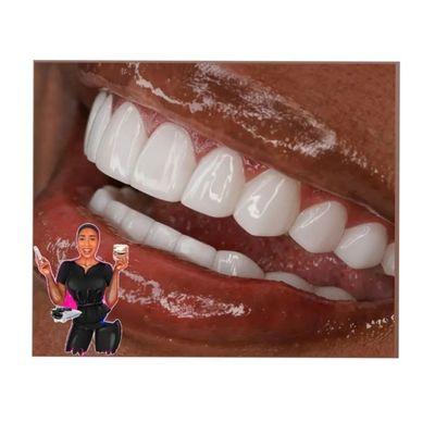 Porcelain Veneers