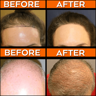 We offer a variety of hair loss treatments to meet your needs, including the automated Follicular Unit Extraction (FUE) method.