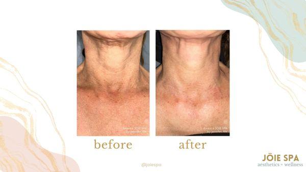 Skin tightening on chin, neck, and submental area at JOIE SPA