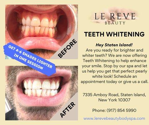 Teeth whitening at LE REVE BEAUTY body spa at Staten Island. Call us for more info or visit our website