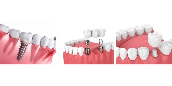 Dr. Charette offers implant therapies for both limited treatment and full mouth reconstructions.