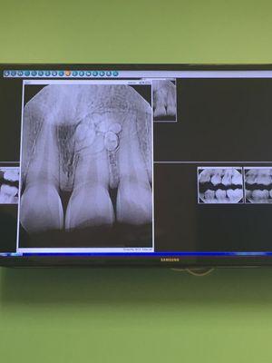 Here's the X-rays for excess teeth. I was told was this is what happens when I don't go to them because I was avoiding their office.