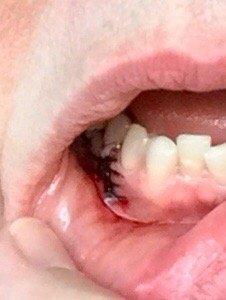 Stitches for a root canal???