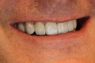 TMJ / pain patient with new smile and no more pain!