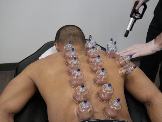 Cupping Therapy. Helps release scar tissue, and fascial adhesions. improves circulation, blood and lymph circulation.