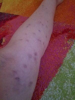 Ugly veins that Kimmel Institute did by injecting my veins in August 2022. Buyer beware!