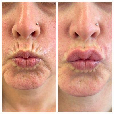 Before and after - lip line filler