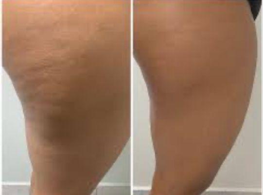 Cellulite Reduction/Skin Tightening results