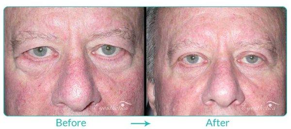 Before and After: Upper Blepharoplasty and Lower Blepharoplasty (Upper and Lower Eyelid Surgery) by Dr. Steven C. Dresner