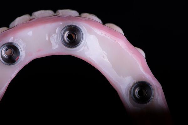 Intaglio of a full arch implant made fully in the USA and milled in Zirconia