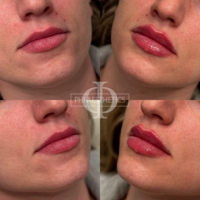 Before and After Lip Filler