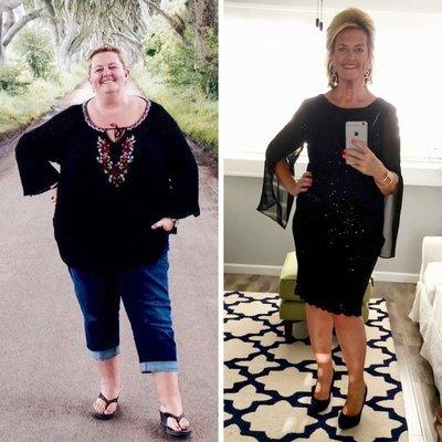 Patient 2016 before and after Gastric Sleeve