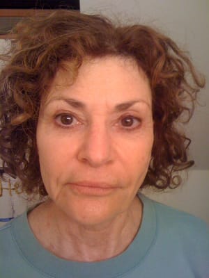 AboutFace facelift massage - After