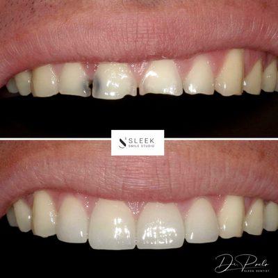 Porcelain crowns and veneers combo