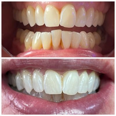 Real people real results, book with All Smiles Teeth Whitening for a professional inexpensive way to whiten your teeth!