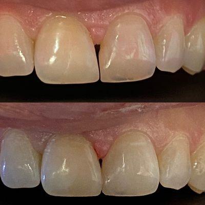 Closing the gap(diastema) with some bonded composite. Additive dentistry, minimally invasive, saving tooth!