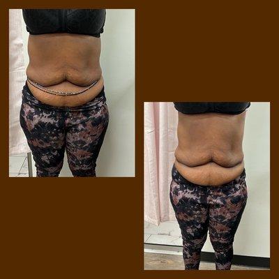 Client trying to get some inches took off her belly. And reduce the extra fat