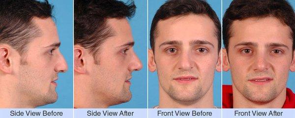 Rhinoplasty Surgery Before & After